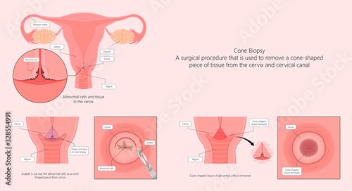Cold knife cone biopsy Loop Electrosurgical Excision Procedure LEEP Large Loop Excision of the Transformation Zone LLETZ remove tissue from the cervix for precancerous cell laser diathermy per treat
