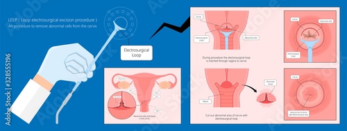 Cold knife cone biopsy Loop Electrosurgical Excision Procedure LEEP Large Loop Excision of the Transformation Zone LLETZ remove tissue from the cervix for precancerous cell laser diathermy per treat