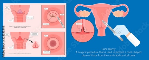 Cold knife cone biopsy Loop Electrosurgical Excision Procedure LEEP Large Loop Excision of the Transformation Zone LLETZ remove tissue from the cervix for precancerous cell laser diathermy per treat
