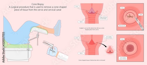 Cold knife cone biopsy Loop Electrosurgical Excision Procedure LEEP Large Loop Excision of the Transformation Zone LLETZ remove tissue from the cervix for precancerous cell laser diathermy per treat