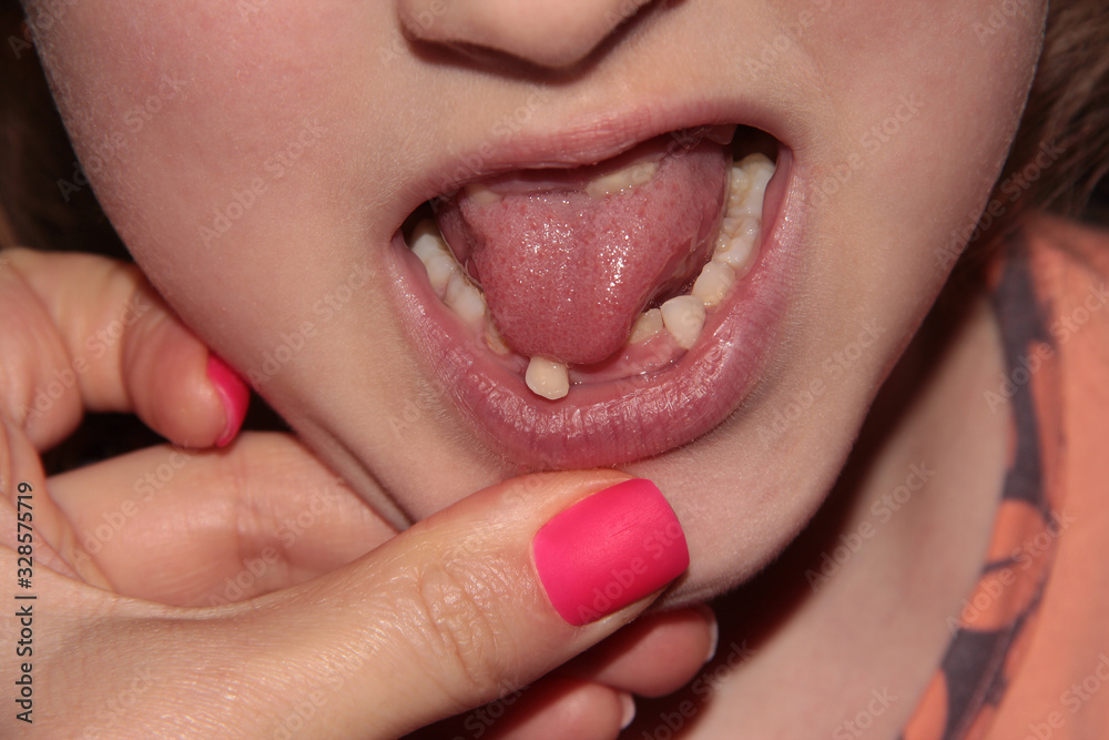 Naklejka premium A child's mouth with a moving tooth. Pink matte nail Polish.