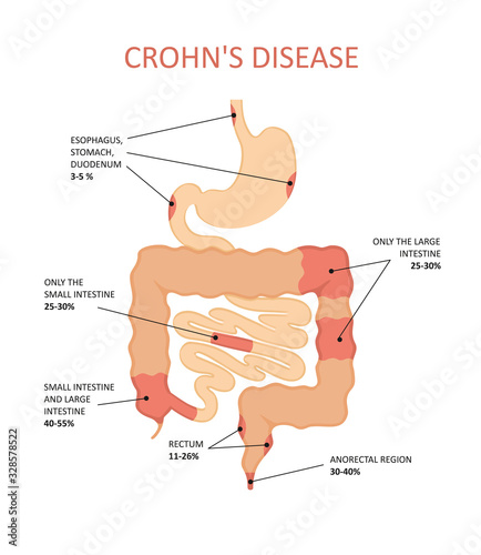 Crohn's disease. Inflammatory bowel disease.