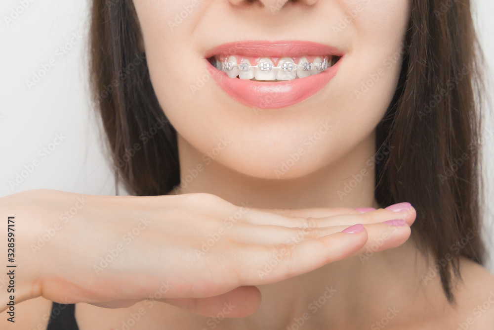 Obraz premium Young woman smile with dental braces. Brackets on the teeth after whitening. Self-ligating brackets with metal ties and gray elastics or rubber bands. Orthodontic teeth treatment