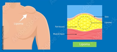 Lipoma disease tissue fatty grows body skin soft hurt pain madelung diagnose physical exam biopsy test 