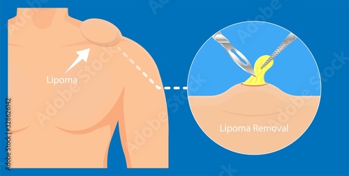 Lipoma disease tissue fatty grows body skin soft hurt pain madelung diagnose physical exam biopsy test  photo