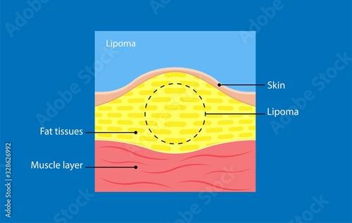 Lipoma disease tissue fatty grows body skin soft hurt pain madelung diagnose physical exam biopsy test 