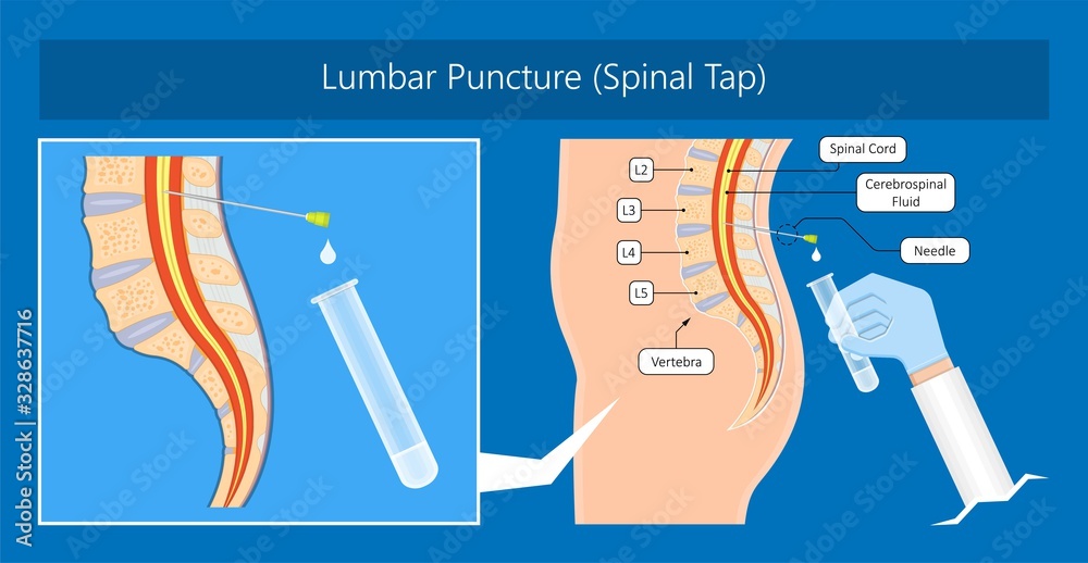 Vecteur Stock lumbar puncture spinal tap canal diagnostic collect sample  patient treat MS tumor exam drug measure pressure CSF lab white blood cell  fluid barre back sclerosis cerebri cord hemorrhage column