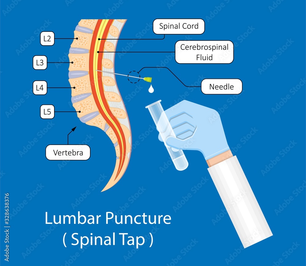 lumbar puncture spinal tap canal diagnostic collect sample patient treat MS tumor exam drug