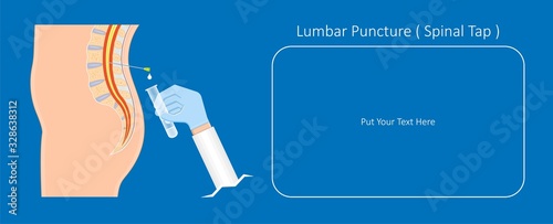 lumbar puncture spinal tap canal diagnostic collect sample patient treat MS tumor exam drug measure pressure CSF lab white blood cell fluid barre back sclerosis cerebri cord hemorrhage column