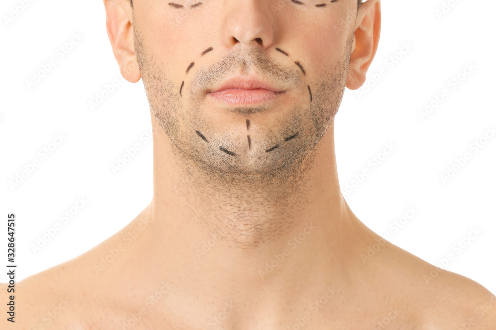 Young man with marks on his face against white background, closeup. Concept of plastic surgery Young man with marks on his face against white background, closeup. Concept of plastic surgery