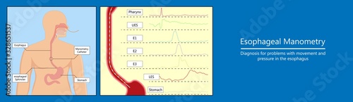 Esophageal manometry test esophageal diagnose food high resolution impedance HRM difficulty swallowing Achalasia treat acid