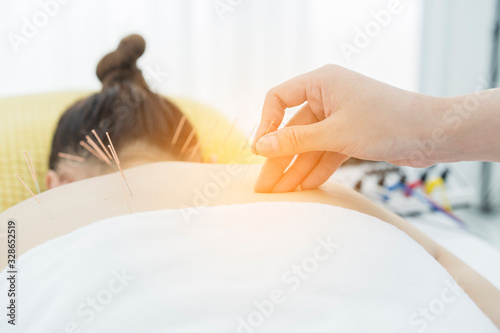 Fotografie Hands of doctor with therapy holding sticks needles into the girl's body, acupuncture can be good alternative for the treatment of back pain, migraine or insomnia