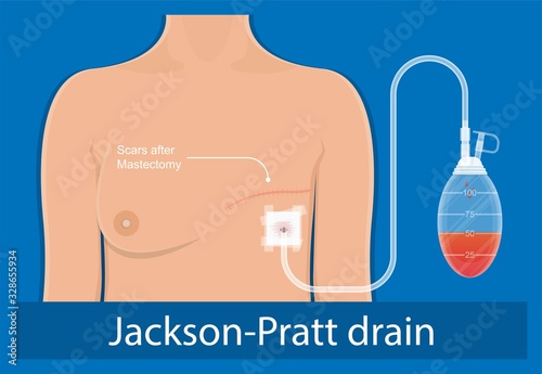 mastectomy breast cancer axillary lymph node dissection chance prevent risk mammography recovery detect diagnosis mammogram symptom infection fluid swelling pain hormonal life bruise bleeding illness photo