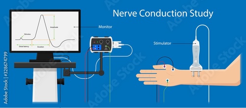 Myasthenia gravis (MG) disease treatment diagnosis testing Electroneuromyography Bell’s palsy Electromyogram problem muscular Motor Carpal tunnel syndrome Cubital Guillain Barre Peripheral neuropathy