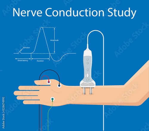 Myasthenia gravis (MG) disease treatment diagnosis testing Electroneuromyography Bell’s palsy Electromyogram problem muscular Motor Carpal tunnel syndrome Cubital Guillain Barre Peripheral neuropathy