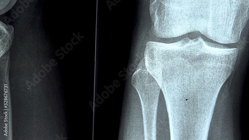 X-ray of the knee joint close-up. X-ray image from bottom to top photo