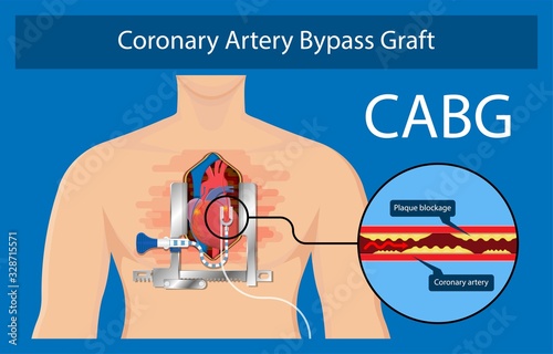 Coronary artery bypass grafting CABG open heart surgery surgical blocked fatty material forms transplant operation attack beating CAD treat CPB