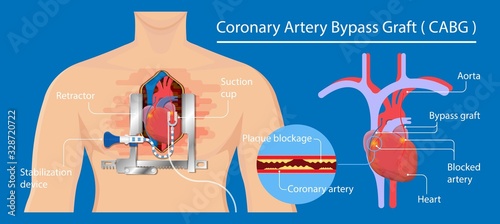 Coronary artery bypass grafting CABG open heart surgery surgical blocked fatty material forms transplant operation attack beating CAD treat CPB