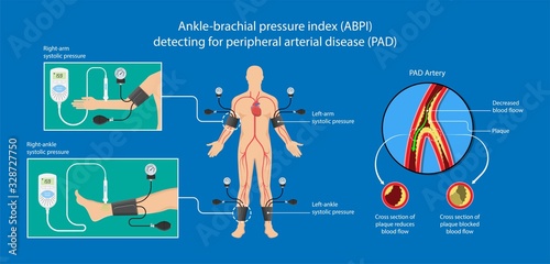 Peripheral artery disease ankle brachial index ABI test limb ischemia diagnosis vascular ABPI blockage photo