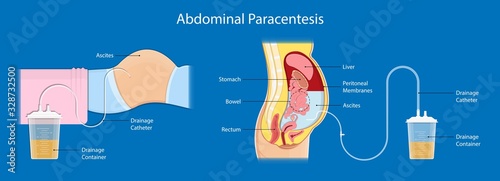 Ascites Paracentesis medical procedure diagnostic abdominal bacteria treatment therapy drainage