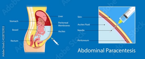 Ascites Paracentesis medical procedure diagnostic abdominal bacteria treatment therapy drainage