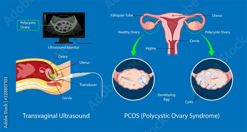 polycystic ovary syndrome PCOS hormonal diagnose diagnostic exam abnormal cancer fertility cysts physical organs blood transducer probe abdominal bleeding pain ectopic pregnancy uterine