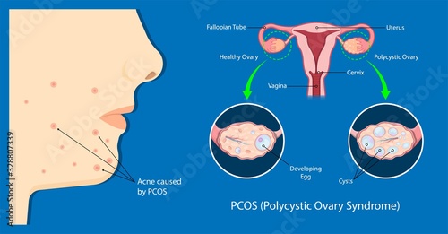 polycystic ovary syndrome PCOS hormonal diagnose diagnostic exam abnormal cancer fertility cysts physical organs blood transducer probe abdominal bleeding pain ectopic pregnancy uterine