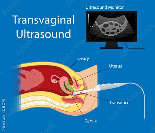 polycystic ovary syndrome PCOS hormonal diagnose diagnostic exam abnormal cancer fertility cysts physical organs blood transducer probe abdominal bleeding pain ectopic pregnancy uterine