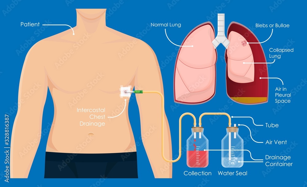 pneumothorax chest tube