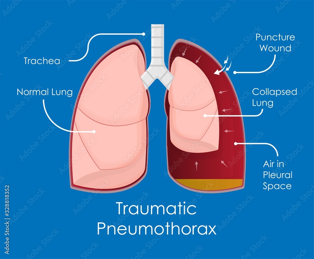 Symptom Spontaneous Iatrogenic Traumatic Pneumothorax Patient with