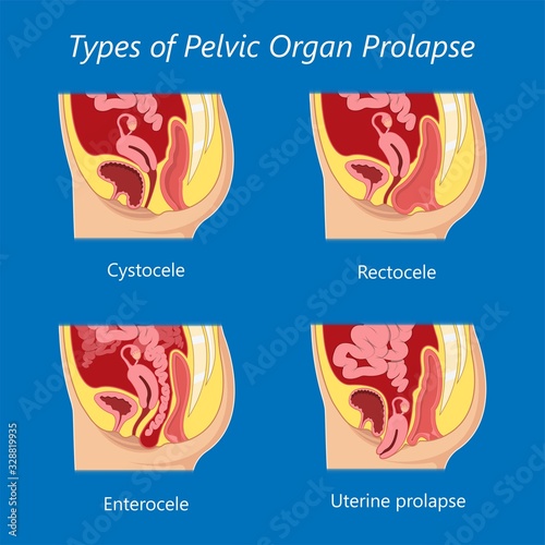 Pelvic floor prolapse type uterine uterus biofeedback pelvic floor treatment stage degree Kegel exercise surgery surgical therapy disorder cystocele urethrocele vaginal vault enterocele urethral exam photo