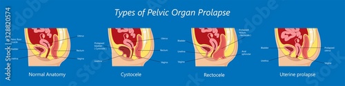 Pelvic floor prolapse type uterine uterus biofeedback pelvic floor treatment stage degree Kegel exercise surgery surgical therapy disorder cystocele urethrocele vaginal vault enterocele urethral exam