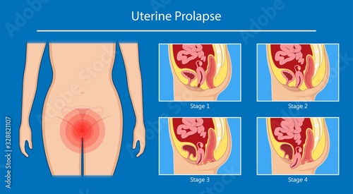 Pelvic floor prolapse type uterine uterus biofeedback pelvic floor treatment stage degree Kegel exercise surgery surgical therapy disorder cystocele urethrocele vaginal vault enterocele urethral exam