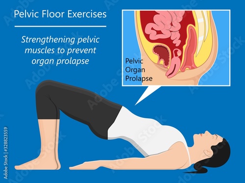 Pelvic floor prolapse type uterine uterus biofeedback pelvic floor treatment stage degree Kegel exercise surgery surgical therapy disorder cystocele urethrocele vaginal vault enterocele urethral exam