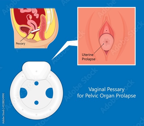 Pelvic floor prolapse type uterine uterus biofeedback pelvic floor treatment stage degree Kegel exercise surgery surgical therapy disorder cystocele urethrocele vaginal vault enterocele urethral exam