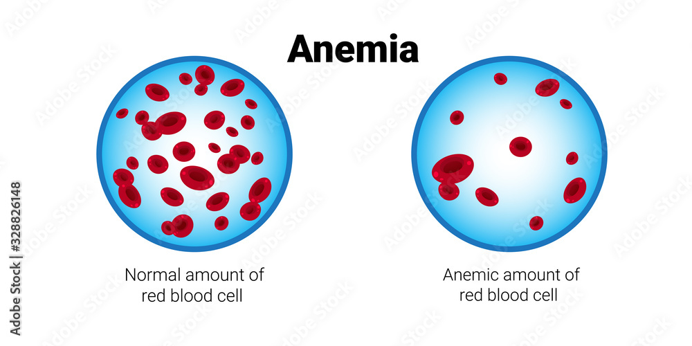 of normal and anemia amount of red blood cells medical board iron
