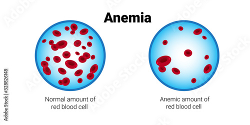 of normal and anemia amount of red blood cells medical board iron deficiency anemia concept horizontal vector illustration