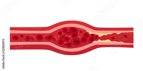 blocked blood vessel artery with cholesterol buildup cells creating blockage in artery thrombosis medical concept horizontal vector illustration