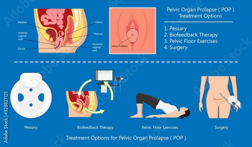 Pelvic floor prolapse type uterine uterus biofeedback pelvic floor treatment stage degree Kegel exercise surgery surgical therapy disorder cystocele urethrocele vaginal vault enterocele urethral exam