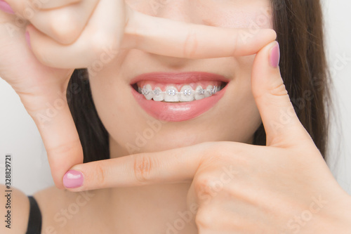 Dental braces in happy womans mouths through the frame. Brackets on the teeth after whitening. Self-ligating brackets with metal ties and gray elastics or rubber bands for perfect smile photo