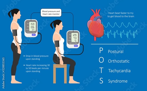 Postural Orthostatic Tachycardia Syndrome POTS intolerance tilt table test Dysautonomia low volume diagnosed measure pulse abnormal fast vessels fainting lightheadedness dizziness procedure breathing