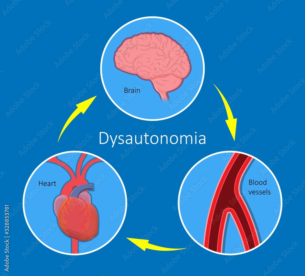 Postural Orthostatic Tachycardia Syndrome POTS intolerance tilt table