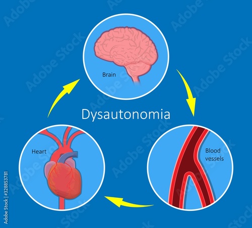 Postural Orthostatic Tachycardia Syndrome POTS intolerance tilt table test Dysautonomia low volume diagnosed measure pulse abnormal fast vessels fainting lightheadedness dizziness procedure breathing