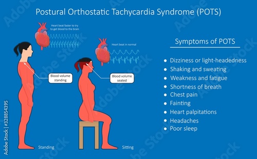 Postural Orthostatic Tachycardia Syndrome POTS intolerance tilt table test Dysautonomia low volume diagnosed measure pulse abnormal fast vessels fainting lightheadedness dizziness procedure breathing