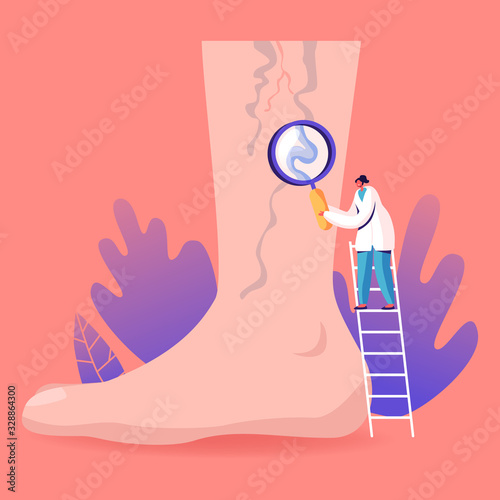Vein Thrombosis and Varicose Treatment Concept. Tiny Doctor Character Stand on Ladder with Magnifying Glass Looking on Huge Foot with Diseased Veins. Health Care, Podiatry. Cartoon Vector Illustration