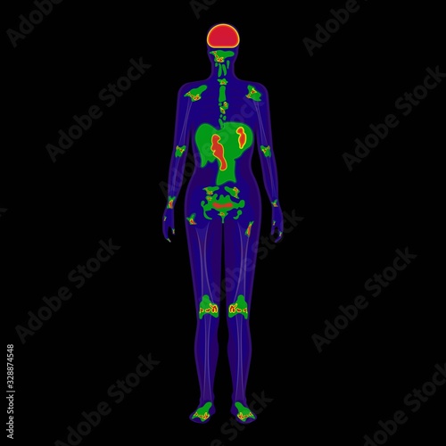 SPECT scan radiologist single computed image CT PET 3D radiotracer Radioiodine I-131 examines uptake treat iodine radiology radioactive diagnosis diagnose radioisotopes radiopharmaceuticals