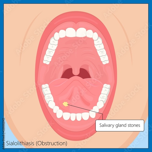 Parotid gland Sialadenitis bacterial infection Sialolithiasis blockage swelling treat Infiltrative cancer ear nose doctor calculi stones diagnose surgical examination inflammation saliva