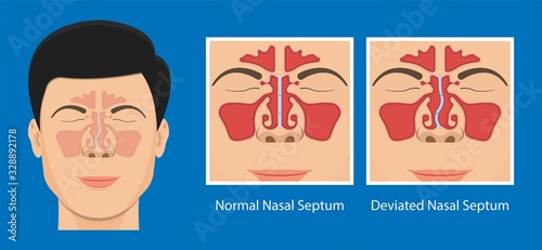 Septoplasty deviated nasal septum breath block blocked swell Nosebleed photo
