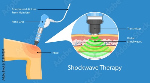 Shockwave therapy SWT physiotherapist treat muscular disorder back neck physical tennis Elbow muscle stimulator ultrasound calcific tendonitis