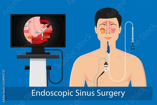 Sinusitis medical disease treat sinuses allergies surgical drug smart ENT endoscopy diagnose